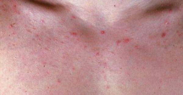 acne how to prevent remotederm