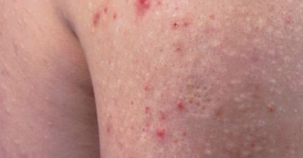 acne treatment remotederm