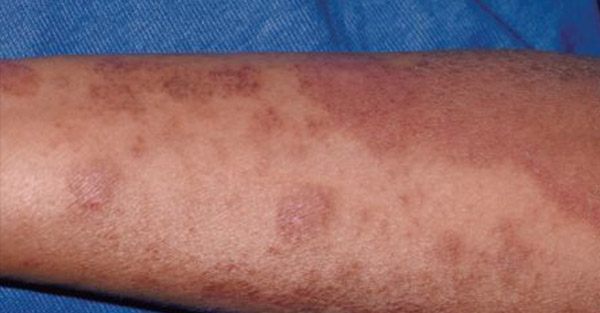 eczema how to prevent remotederm