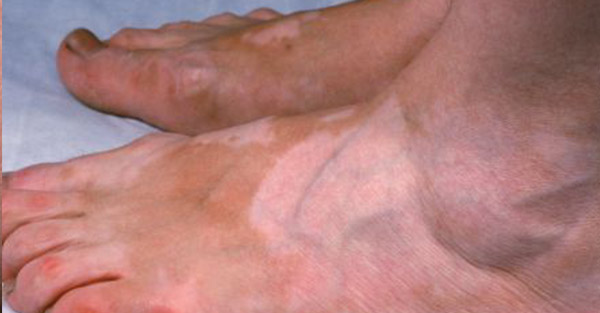 vitiligo-samples-remotederm