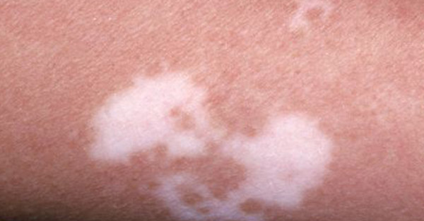 vitiligo_examples-remotederm