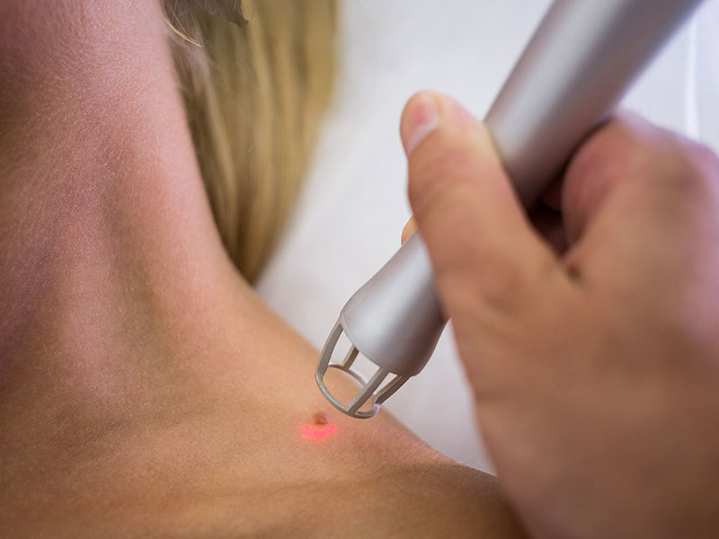Dermatology Laser treatment