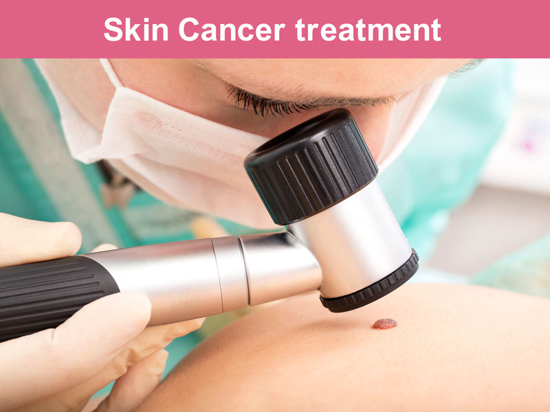 skin cancer treatment