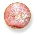 Squamous Cell Carcinoma (SCC) image