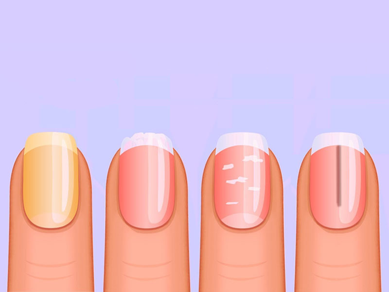 Rippled or pitted nail – Dr Renu Madan