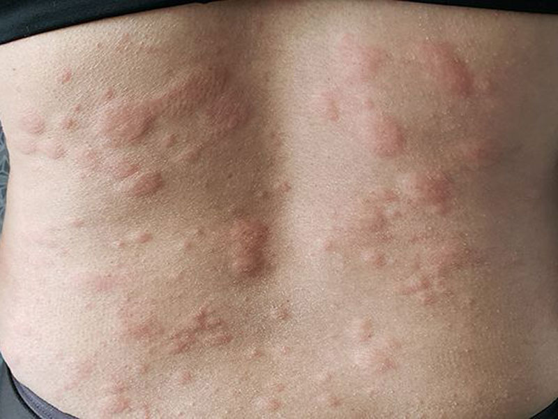 Biologic Therapy For Psoriasis Raleigh Nc