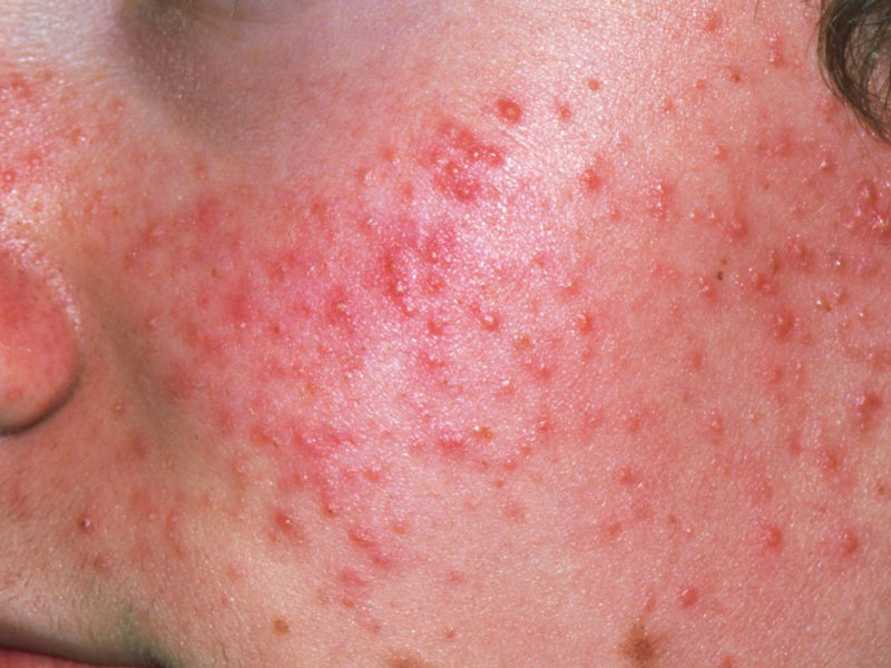 Seborrheic Dermatitis Raleigh Nc