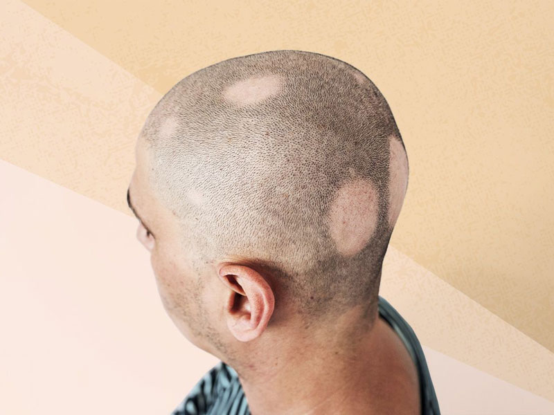 Alopecia Areata