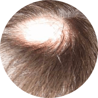 Alopecia Areata