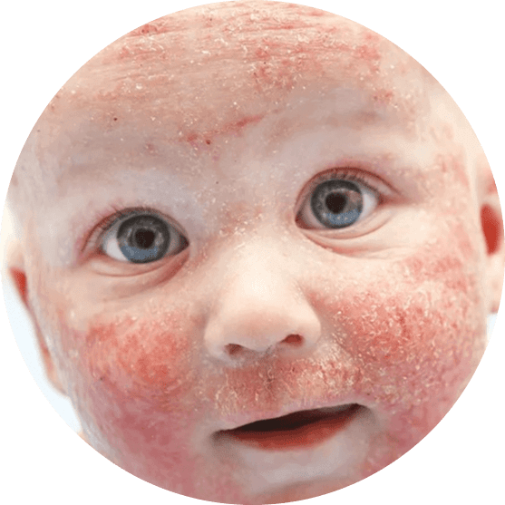 Atopic Dermatitis