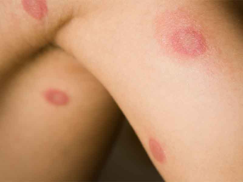 What does a Lyme disease rash look like? - Daniel Cameron, MD, MPH