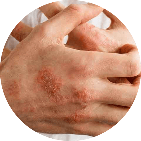 Symptoms of Eczema