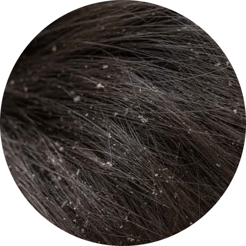 Symptoms of Dandruff on dry scalp