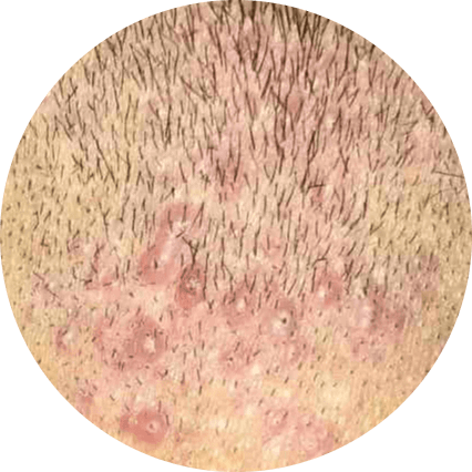 Folliculitis on scalp
