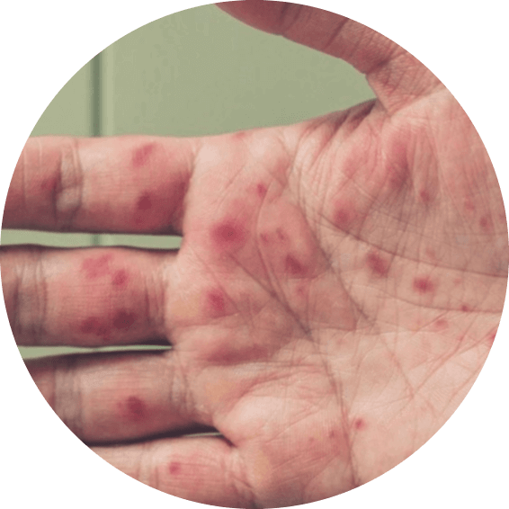 Hand eczema