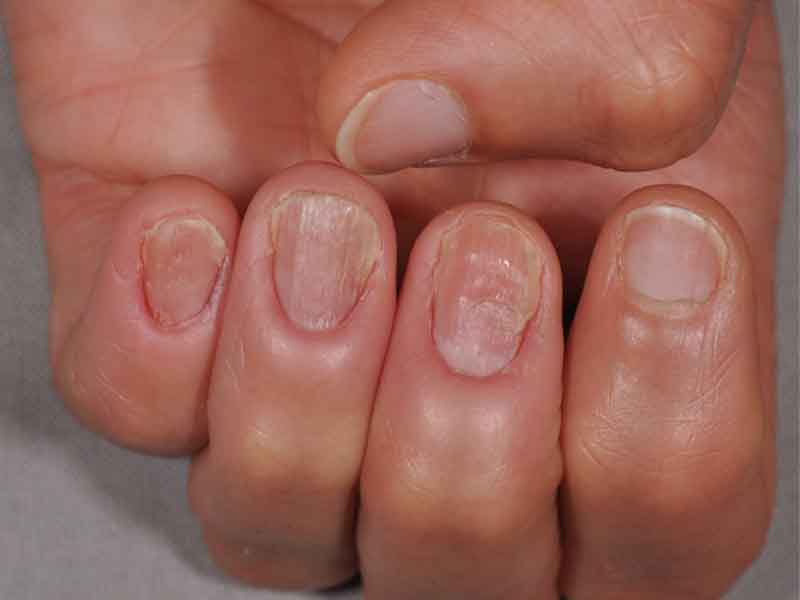 Nail Diseases Chart: Picture, Sign and Treatment