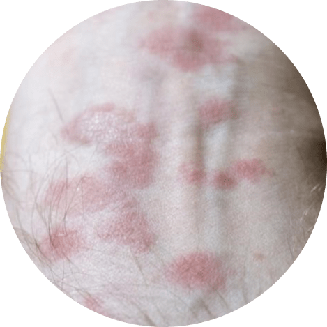 Nummular eczema