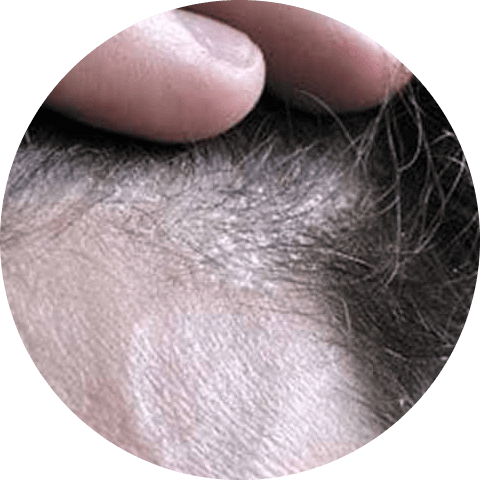 Seborrheic dermatitis on scalp