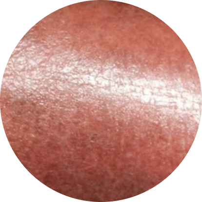 Stasis dermatitis