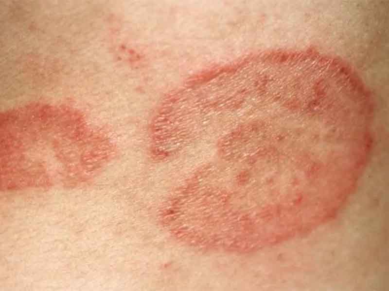 Pityriasis Rosea: Stages, Photos, Treatments