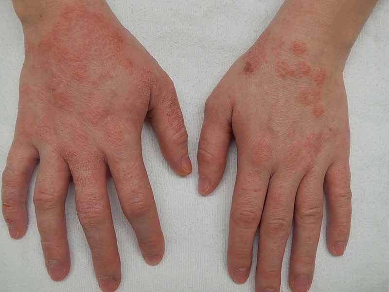 A close-up of eczema on the hands, one of the common types of eczema.