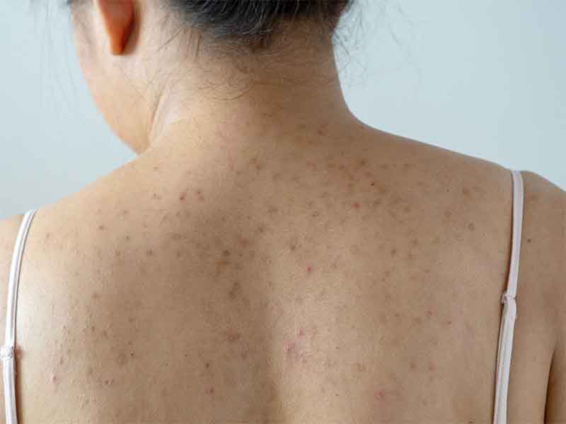 Acne dark spots on back