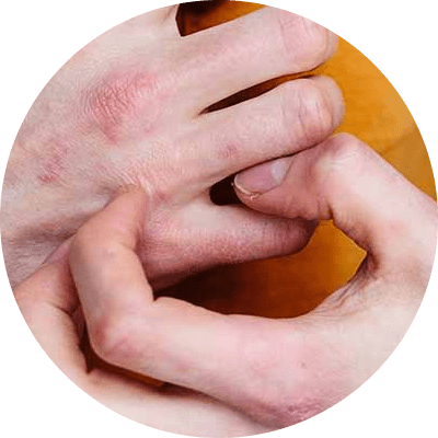 What is eczema
