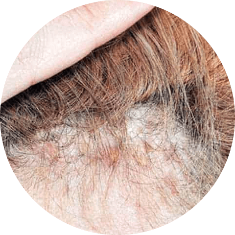 Eczema on scalp