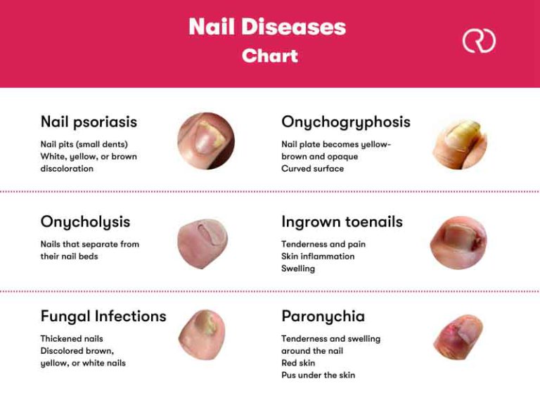 Nail Diseases Chart: Picture, Sign and Treatment