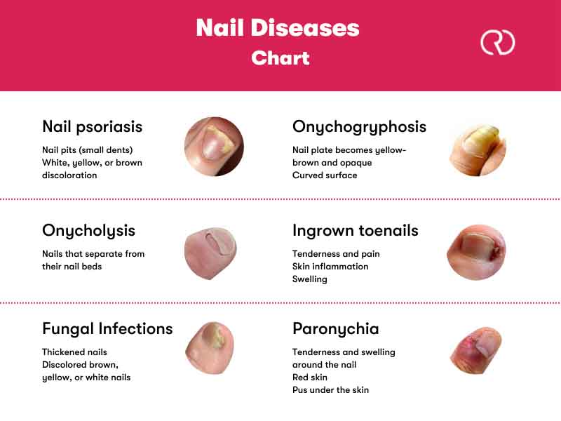 15 Fingernail and Toenail Abnormalities