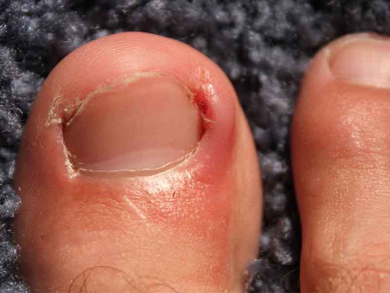 Ingrown toenail