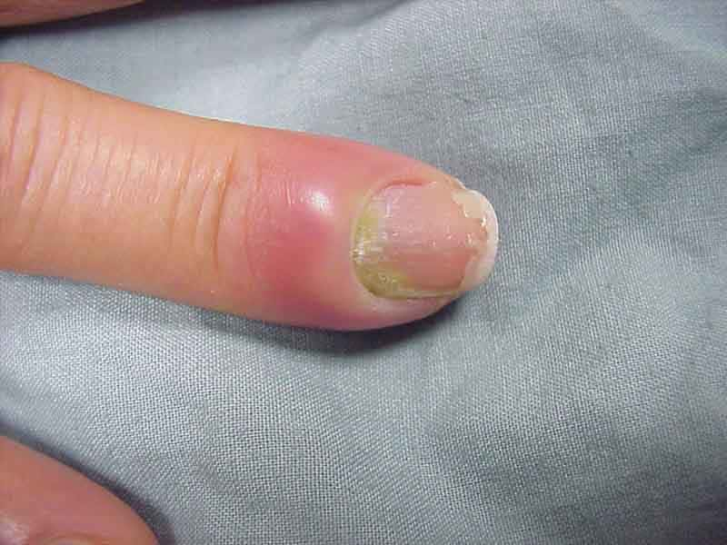 Paronychia (Nail Infection): What Is It, Symptoms, Causes and Treatment