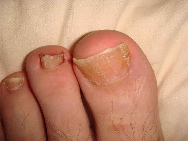 75-year-old man • recent history of hand-foot-mouth disease • discolored  fingernails and toenails lifting from the proximal end • Dx? | MDedge  Family Medicine