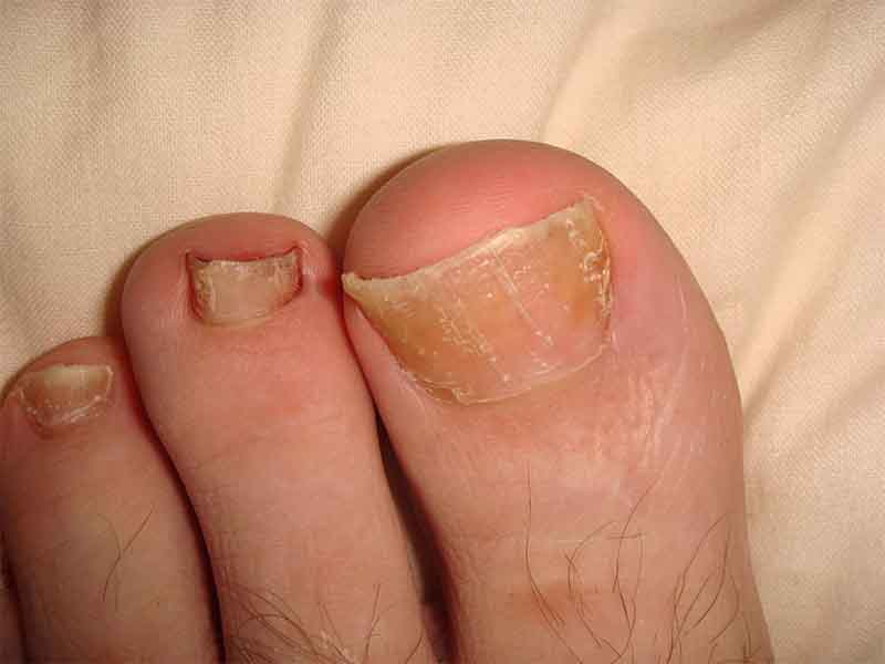 Comprehensive Toenail Problem Guide