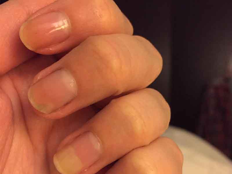 Onycholysis (Nail Separation): Symptoms, Causes & Treatment