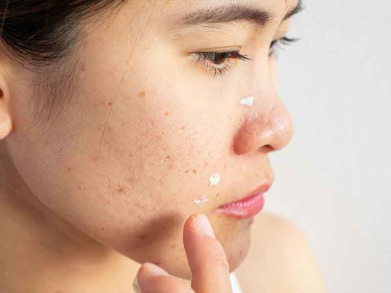 Acne Treatment options