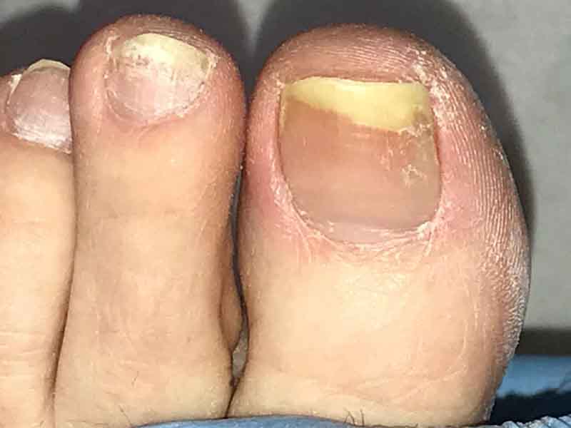 Nail Diseases Chart: Picture, Sign and Treatment