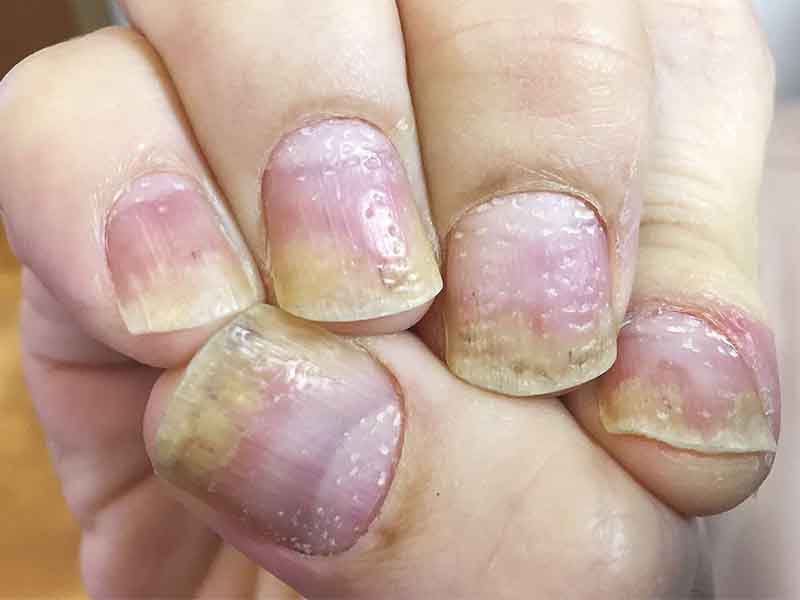 Optimal management of nail disease in patients with psoriasis | PTT