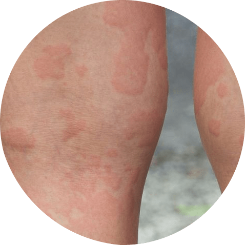 Hives on the back of the knee