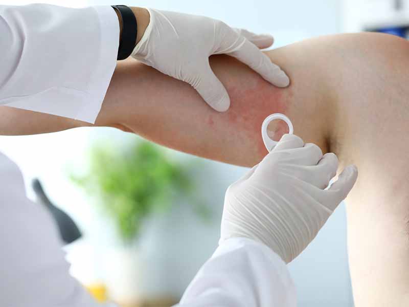Visit a dermatologist for hives treatment