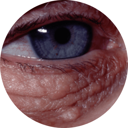 Sebaceous Hyperplasia Symptoms On Eye