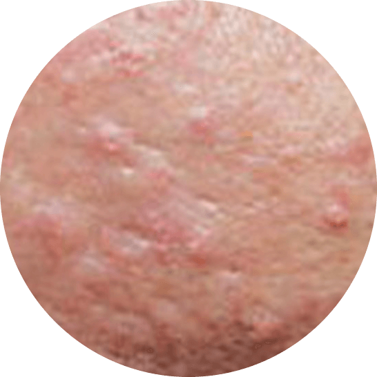 Sebaceous Hyperplasia close-up photo