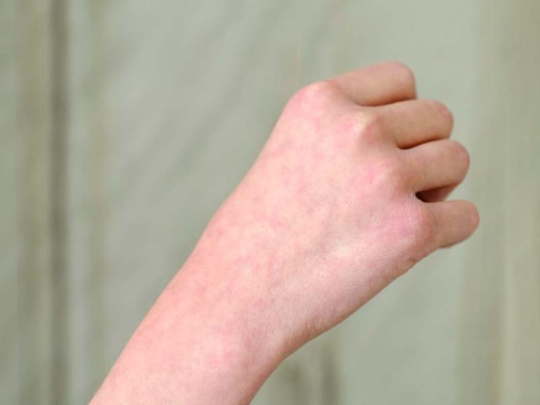 Skin Rash Types, Causes, Treatment, Prevention - Remotederm