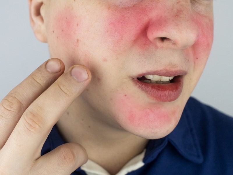 Person touching rosacea on face