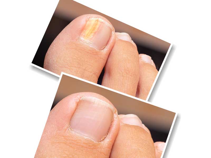 Treatment procedures for Nail Fungus
