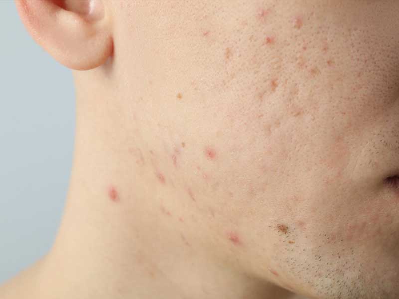 Acne scars on skin