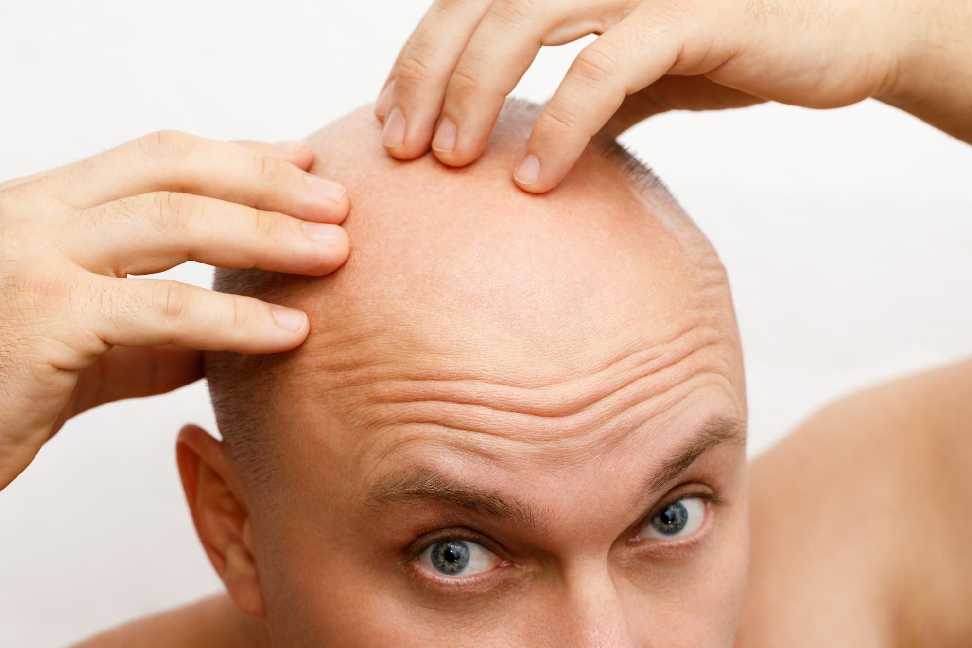 Alopecia Totalis Cure and Treatment 