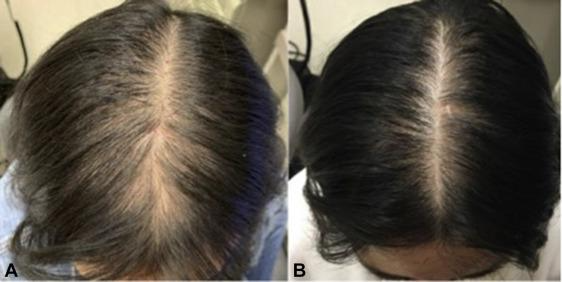 Female Pattern Alopecia: Causes & Treatments- Remotederm