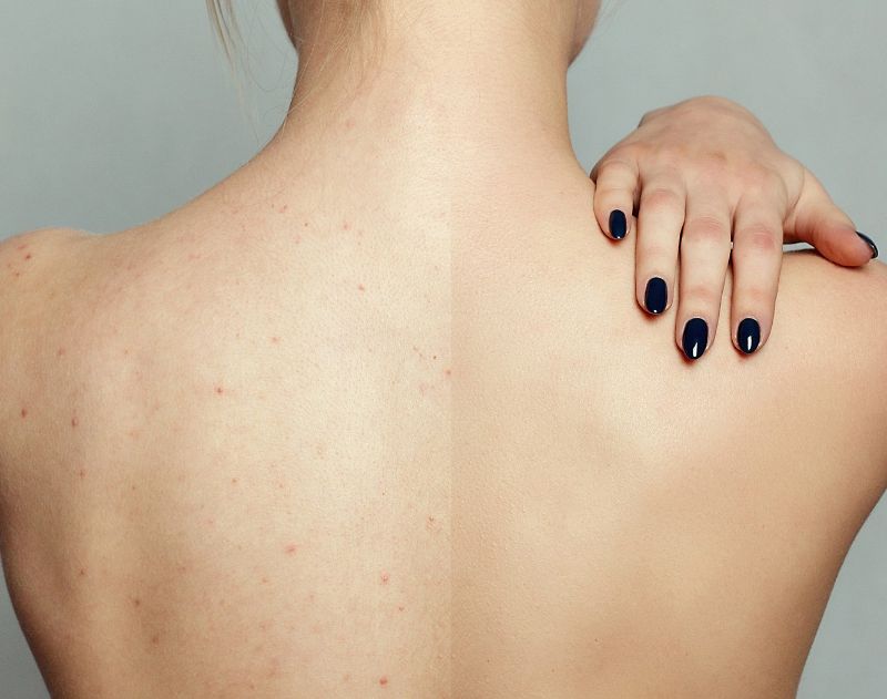 Getting rid of Back Acne