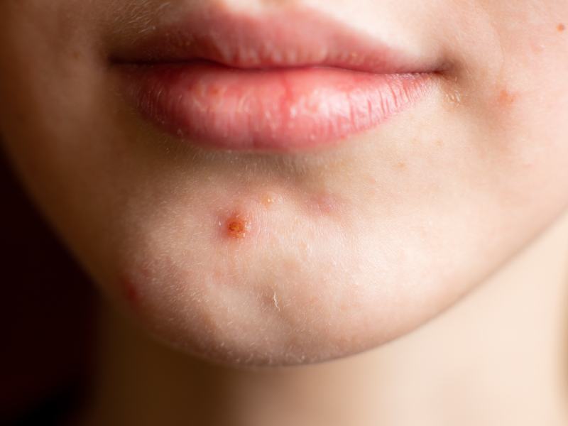 Spicy Food and Acne: Does Spicy Food Cause Acne - RemoteDerm